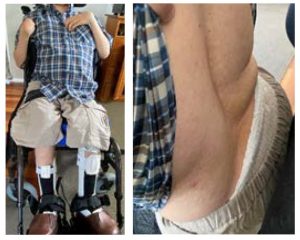 Imagen 2: Sentado en silla de ruedas vista de frente Imagen 3: Forma actual de la espalda de Jesse sentado